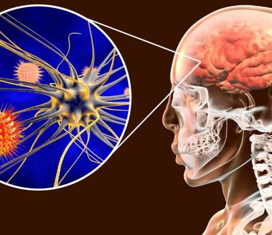 Sintomas de la Meningitis