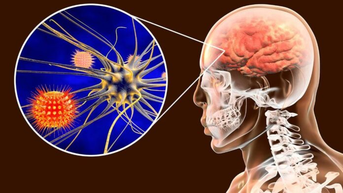 Sintomas de la Meningitis