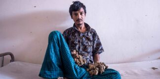 Hombre árbol: «Ya no soporto el dolor» y pide ser amputado Hombre-árbol-de-Bangladesh-cantineoqueteveonews