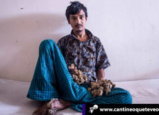 Hombre árbol: «Ya no soporto el dolor» y pide ser amputado Hombre-árbol-de-Bangladesh-cantineoqueteveonews