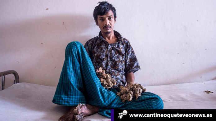 Cantineo-WEB-Hombre-árbol-de-Bangladesh-Ya-no-soporto-el-dolor-y-pide-ser-amputado Hombre-árbol-de-Bangladesh-cantineoqueteveonews