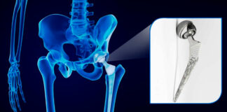 Investigación a mayor farmacéutica Johnson & Johnson por prótesis defectuosa cantineoqueteveo news - Investigación a Johnson & Johnson