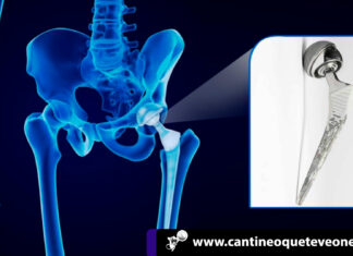 Investigación a mayor farmacéutica Johnson & Johnson por prótesis defectuosa cantineoqueteveo news - Investigación a Johnson & Johnson