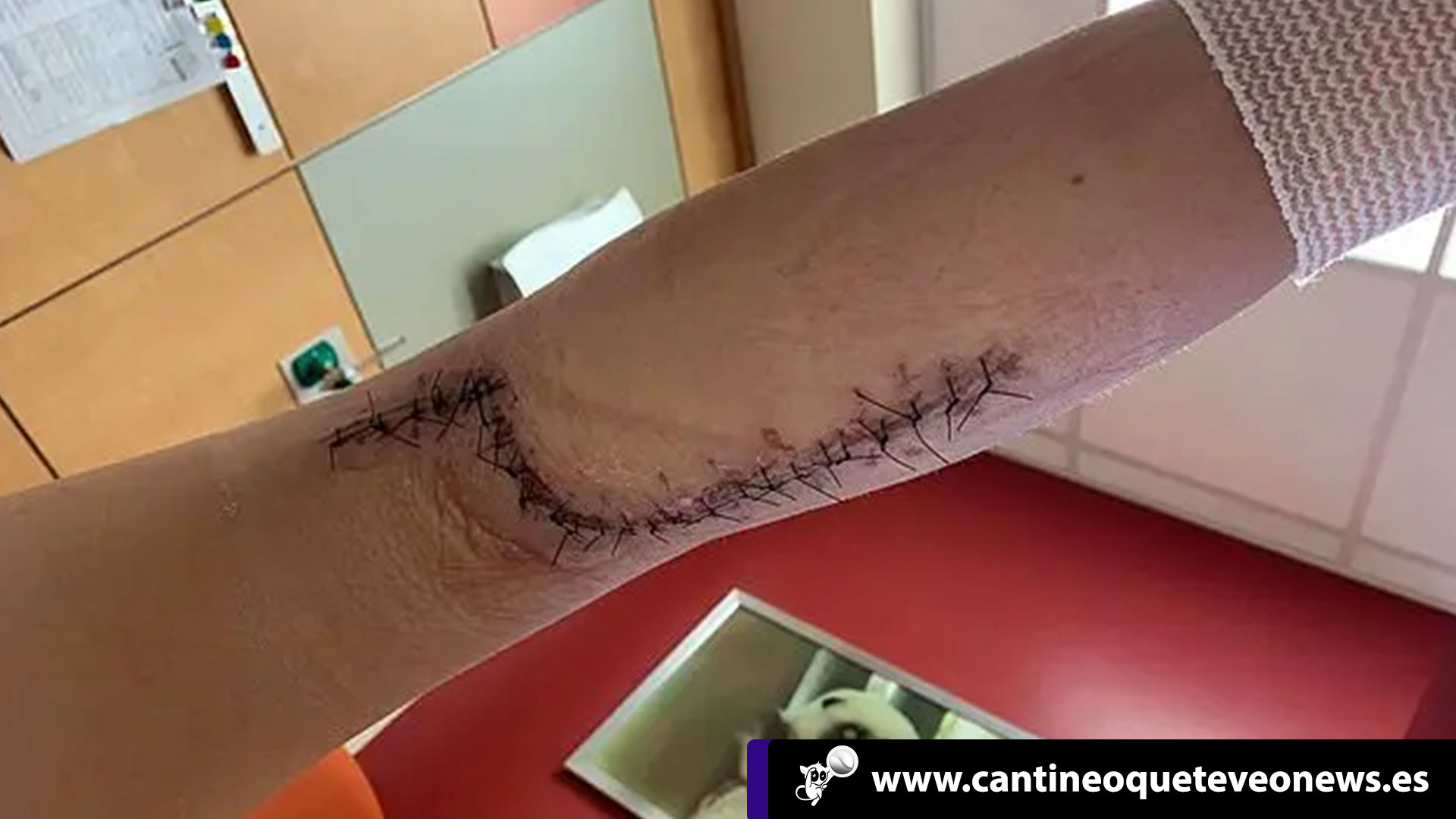 Cantineoqueteveo News - Niña infectada por bacteria