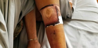 Niña casi muere infectada por bacteria come carne en playas de Florida Cantineoqueteveo News - Niña infectada por bacteria