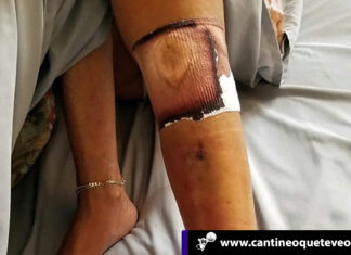 Niña casi muere infectada por bacteria come carne en playas de Florida Cantineoqueteveo News - Niña infectada por bacteria