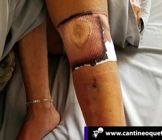 Niña casi muere infectada por bacteria come carne en playas de Florida Cantineoqueteveo News - Niña infectada por bacteria