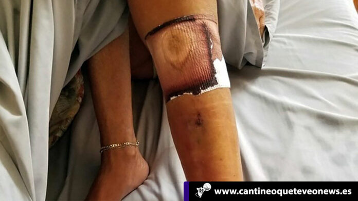 Cantineo-WEB-Niña-casi-muere-infectada-Bacteria-Come-Carne-Playas-Florida1 Cantineoqueteveo News - Niña infectada por bacteria